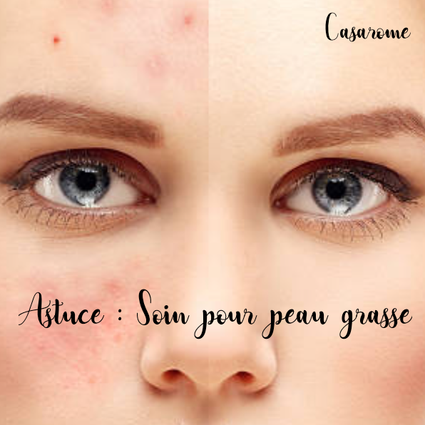 Soin pour peau grasse