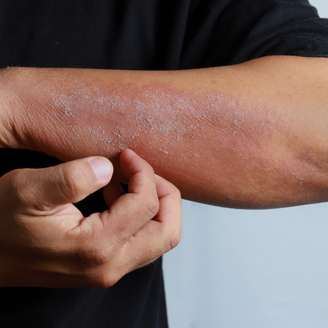 huile nigelle eczema
